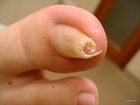 Toenail Fungus Treatment - Home Remedies You Must Try