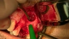 sinus lift et implantation simultanée - sinus floor augmentation with immediat implantation